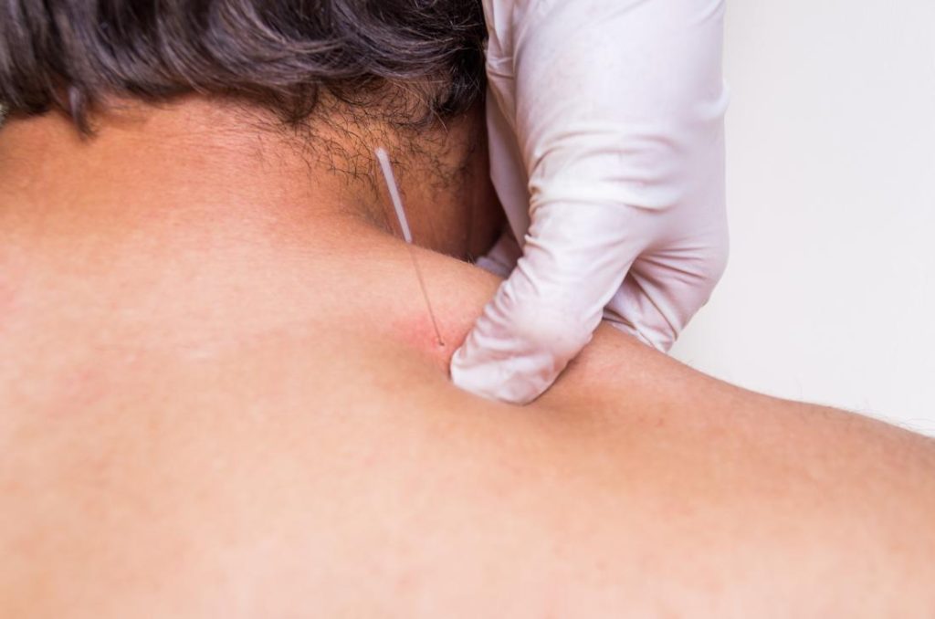 Dry Needling and Acupuncture