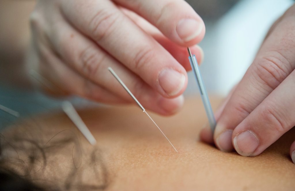 Acupuncture can relief stress