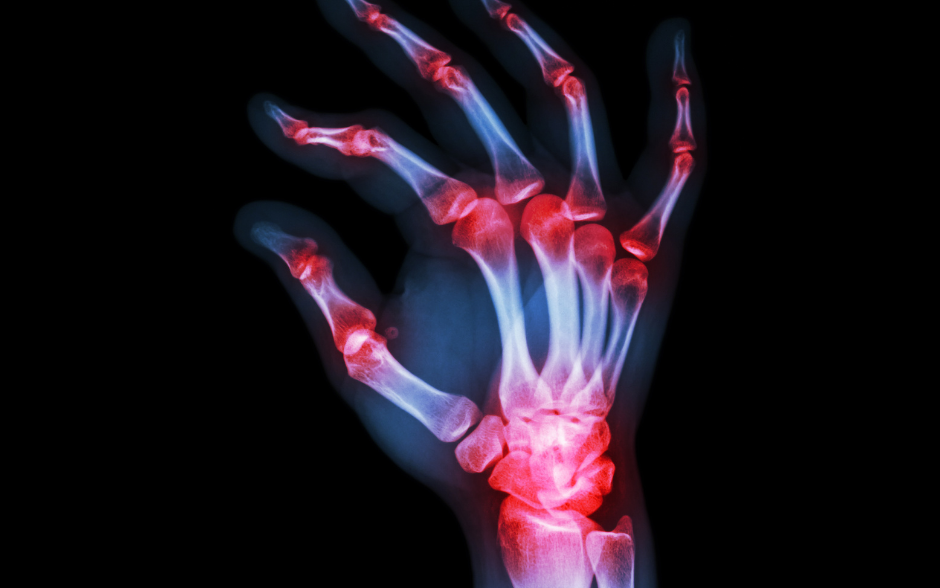 pin points of Arthritis